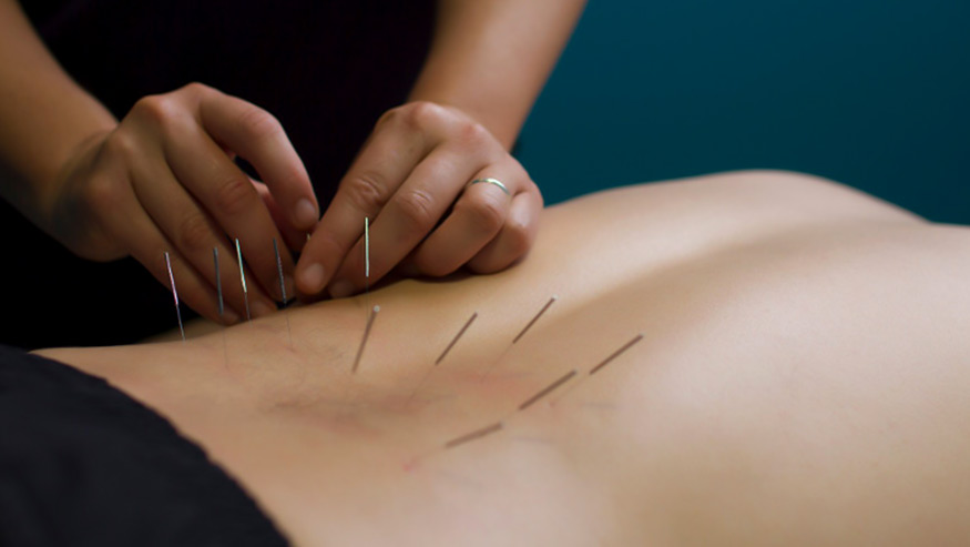 Dry needling یا سوزن خشک 